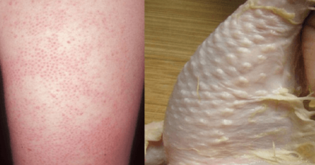 Mira los síntomas que podrían indicar que debes eliminar el gluten Tendencias