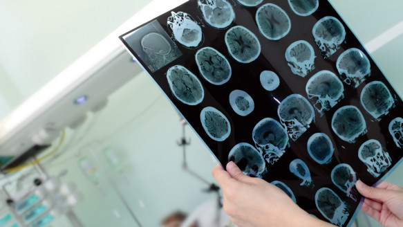 Un estudio clave de los últimos 16 años sobre el alzhéimer pudo haber sido manipulado Salud
