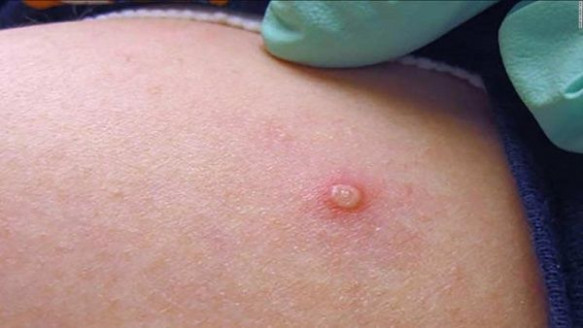 Viruela Símica está por superar los 100 casos en Chile: Especialistas abordan alza sostenida de contagios Salud