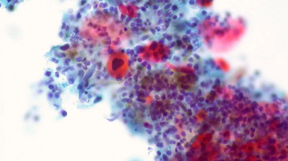 Revelan terapia genética que cura a enfermos de cáncer Ciencia y Tecnología