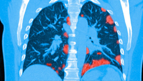 Científicos cubanos investigan uso de células madre en afecciones pulmonares pos-covid-19 Actualidad