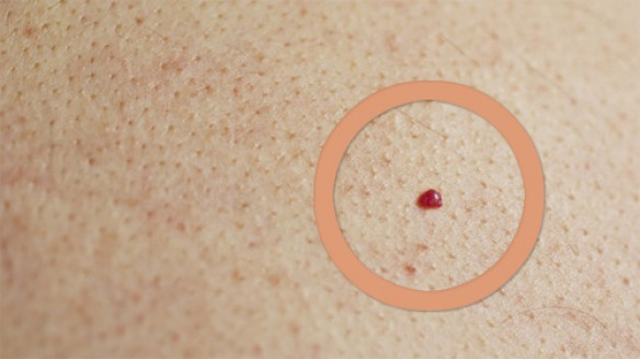Lunares rojos en la piel: ¿A qué se deben? Salud