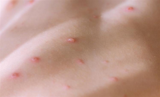 OPS actualizará la situación sobre viruela símica en América Salud