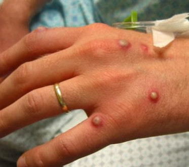 Hombre en Italia dio positivo en viruela del mono, Covid-19 y VIH al mismo tiempo Actualidad