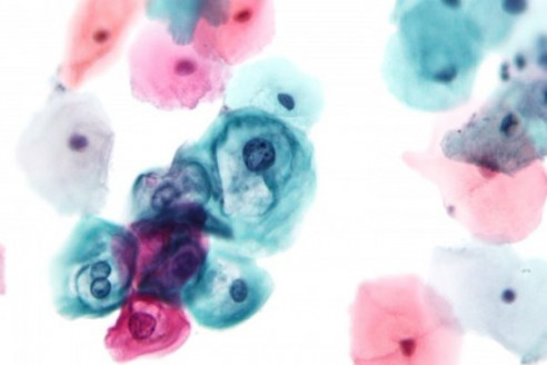 Desarrollan una prueba más precisa para detectar cáncer de cuello uterino Actualidad