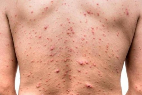 Médicos tendrán que notificar casos de viruela del mono en Reino Unido Salud