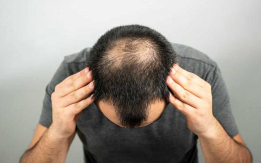 Aprobaron primer tratamiento sistémico contra la alopecia severa en adultos Salud