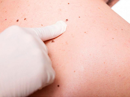 Equipo de especialistas de la U. de Chile desarrolló modelo para detectar melanomas en base a la Inteligencia Artificial Chile