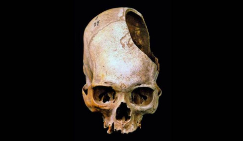 Cirugías de cráneo prehispánicas: Los incas superaban con creces a los cirujanos estadounidenses de la guerra civil Ciencia y Tecnologí­a