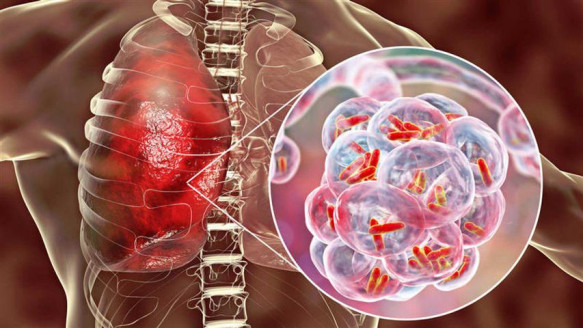 Covid-19 afectó los servicios de atención a quienes padecen tuberculosis Salud