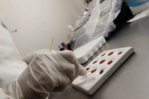 Confirma Salud caso sospechoso de hepatitis aguda infantil en Puebla México