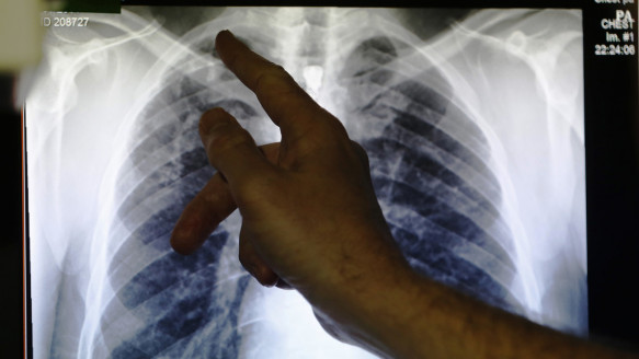Por primera vez en muchos años: OMS registra un aumento de los casos de tuberculosis resistente a fármacos Salud